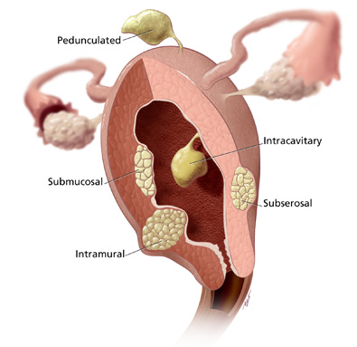 Uterine_cutaway_fibroids